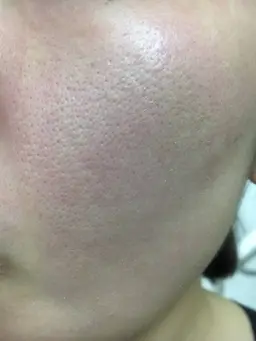 【頭皮マッサージ付】毛穴改善ピールフェイシャル