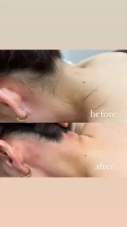 大人気✨うなじ脱毛💎💎