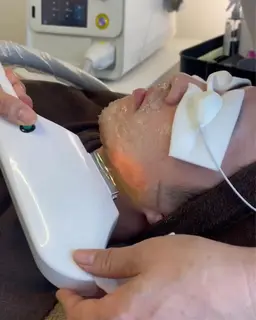 ⚫︎ヒゲ脱毛(保湿パック付き)