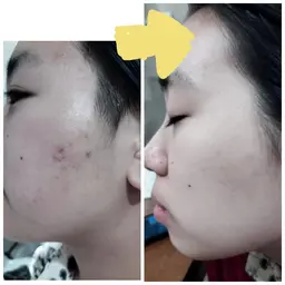 【美白より先の発光肌】低刺激で高い効果😉ニキビのお悩みにも。一度で透明感アップ✨芸能人ピーリングと話題の水光ピーリング