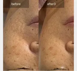 結果重視！純粋レチノールピール🍋