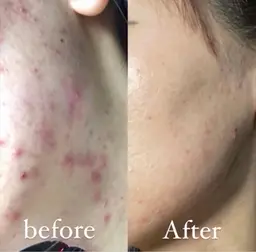 【本気肌質改善】HAABREPRO ハーブピーリング¥10,000-