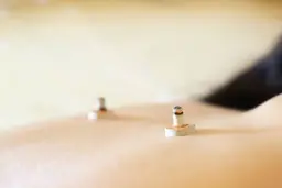 【冷え性、手足の冷え】からだぽかぽか鍼灸【季節限定】