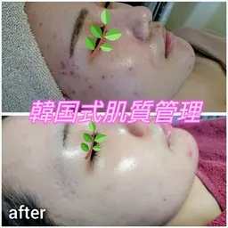 悩んでる方おすすめ❗韓国陶器肌✨頑固なニキビ❗くすみ❗凸凹お肌❗古い角質除去【安全な剥離しないピーリング】潤艶肌✨