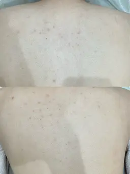 [イベント前に🎈] うなじ背中脱毛⭐️