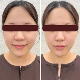 平日限定【むくみ/エラ張り/左右差】初めての小顔矯正60分⭐️フェイスライン