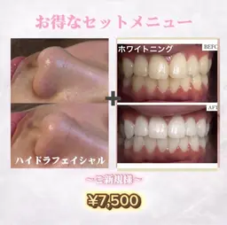 大人気))全顔ハイドラフェイシャル×ホワイトニングのお得なセット🦷🫧✨(ビタミンC超音波導入+ ¥2,000)