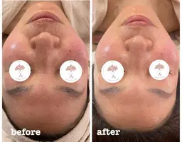 【シミそばかす悩み】ハーブピーリング