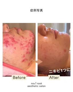 【もう辛いとは言わせない‼️】本気で悩んでいるなら当店人気No.1剥離ありハーブピーリング🌿治せないニキビは無い