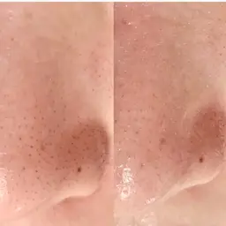 ️🫧ハイドロフェイシャル️🫧水素の力で毛穴をしっかり洗浄❣️毛穴の黒ずみ除去/角質除去