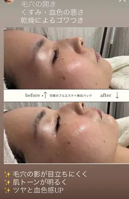 うる艶卵肌フルエステ