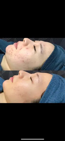 【ニキビ肌、アトピーの方もOK✨】ピーリング導入しました🌿