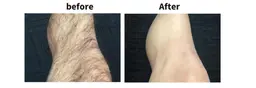 【メンズ脱毛】【ひざ下】痛みなく卒業も早い脱毛★仕上がりのお肌にご満足いただけます★
