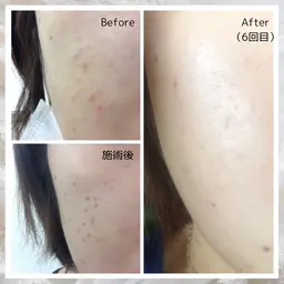 【シミケア30分取り放題】🌸毛穴洗浄×ポレーション（美白&保湿美容液）×シミケア30分