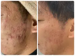 💁‍♂️男性の為の🌿ハーブピーリング🌿【HAAB REPROハーブリプロ】