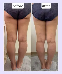 【期間限定モニター】💎ラジオ波×キャビテーション痩身💎（60分）