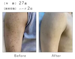 【二の腕ニキビ・毛孔性苔癬】ハーブピーリング