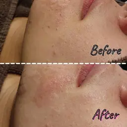 【毛穴汚れ撃退🍓】毛穴エクストラクション 60分 ¥4400【メンズも歓迎✨】