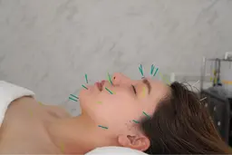 ご新規様限定　美容鍼DOLCEコース