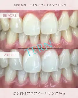 メディカルホワイトニングカウンセリング