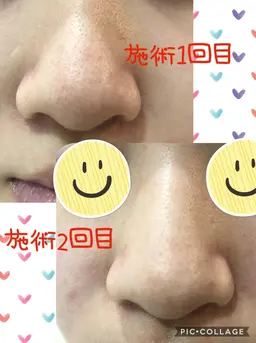 【毛穴吸引&フェイシャルベーシック🍀】気軽にお手入れをしたい方にオススメ🥰ストレス解消にリラックス🌈