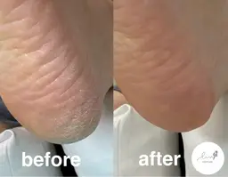 カカトの角質ケア(30分でできる範囲のケアです)