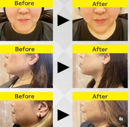 【レモン美容液導入🍋】美肌LED込みの小顔フェイシャル❤️