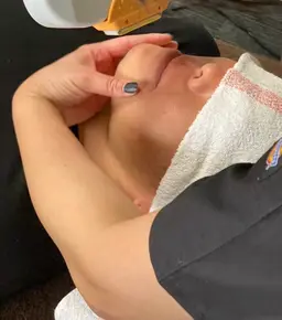 顔脱毛3回セット