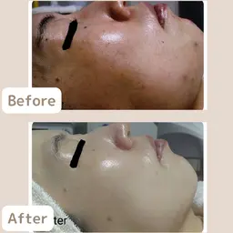 人気NO.1✨《脱ニキビ肌！》社会人🈹本気のニキビケア2回体験　※毛穴ディープクレンジング付　[大阪城北詰/京橋駅]
