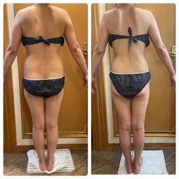 キャビテーション&EMS &超音波