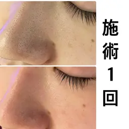 ✨口コミ協力✨【毛穴・角質ケア】肌リセットフェイシャル＋極潤美肌パック🫧