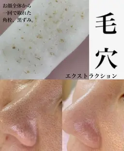 毛穴エクストラクション　モニター（写真撮影可能な方、Instagram投稿時は加工して顔は分からないようにします）