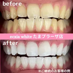 人気No.1!!平均5トーンUP⭐︎たっぷり60分プレミアム歯科ホワイトニング初回体験 ¥14800→¥11000