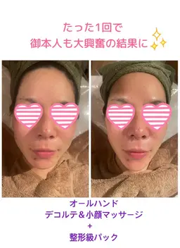 【フェイシャル】整形級✨1回で感動の結果🥹✨小顔マッサージ✖️MTメタトロン✖️母細胞を鍛える炭酸ガスパック　75分