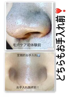 tete式毛穴エクストラクション