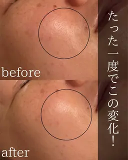 フェイシャルワックス×韓国で話題の炭酸ガスパック　カーボキシー　一度で効果実感！肌質改善！