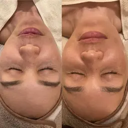 【高濃度炭酸ガスパック✨＋ベーシックフェイシャル90分ハンドケア付き¥9.900⇨8400