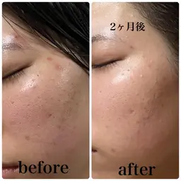 【Xで大バズり中🔥ポーラ肌分析】精密肌カメラを使ったお肌検査👀✨ 肌悩みや自分に合うケアを知りたい方の入口🚪