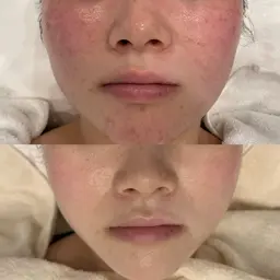 【赤み・ニキビケア】剥離ハーブピーリング＆顔リンパマッサージ¥22000→