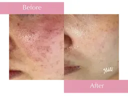 \１周年記念/ ✨【人気No.1💎90分コース】毛穴、肌荒れ、ニキビ集中ケア★美容導入も付けさせていただきます✨️