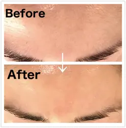 【脱毛●顔脱毛 】平日15時迄の予約限定！waxで美白効果 小鼻の黒ずみ改善  女性限定