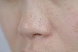 【毛穴ケア(小鼻/頬)】黒ずみ毛穴/開き毛穴にお悩みの方！毛穴集中エステ✨(ショルダーマッサージ付です♪)