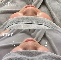 ヘッド(頭皮)筋膜リリース