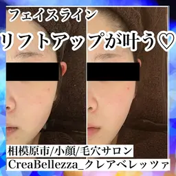 小顔リフトアップコース