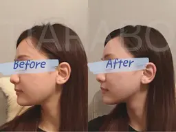 【贅沢小顔美容鍼110分】全身鍼 美容鍼＆低周波デコルテ​〜​小顔リンパラジオ波&筋膜ほぐし+高保湿パック+ドライヘッドスパ