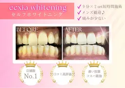 セルフホワイトニング(9分×2セット)¥3980→¥500