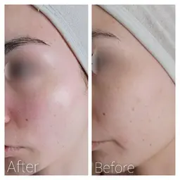 V.O.S肌再生トリートメント+ドライヘッドスパ付き