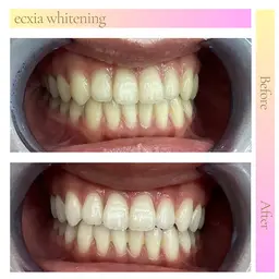 【minimo掲載記念】セルフホワイトニング（9分×2回）¥980 別途料金なし