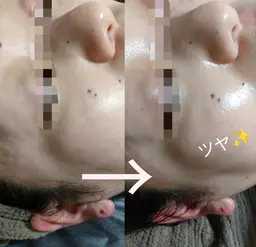 【新規】美肌を作るマツヤニWAX+泥バック 毛穴ケア、産毛脱毛