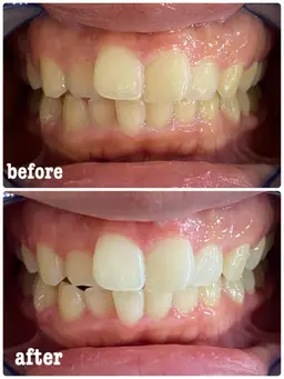 10代学生さん限定プラン💛(18歳まで)15分×2回照射🦷✨